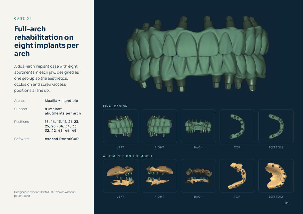 Full-arch rehabilitation on eight implants per arch, designed in exocad