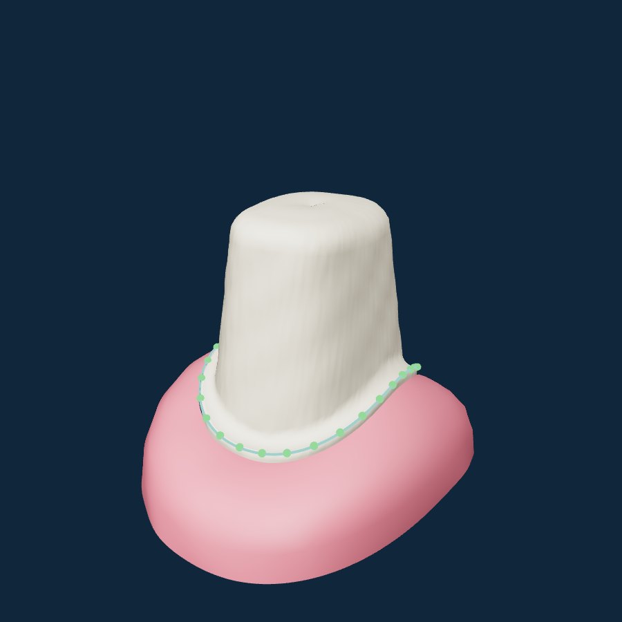 Margin Master: a premolar preparation with a traced margin line